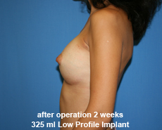 plastic-surgery-breast-augmentation